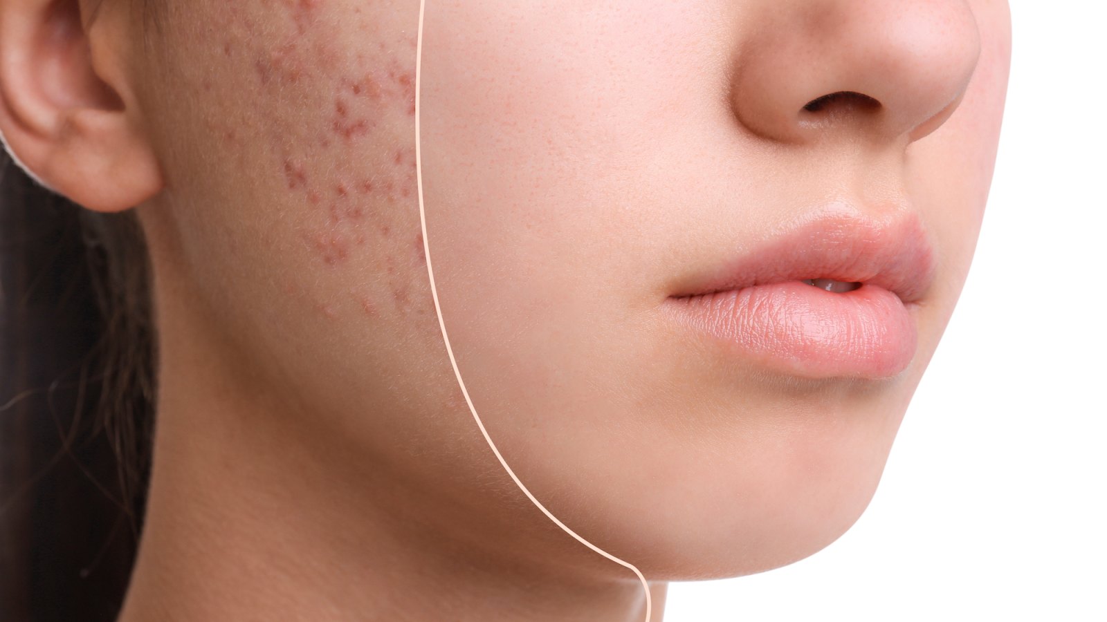 Before-After-Acne-Spot-Treatment-Stock-Photo