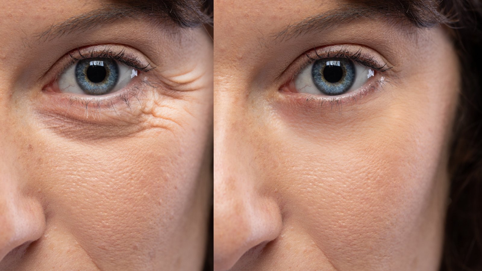 before-After-Crows-Feet-Treatment-Stock-Photo