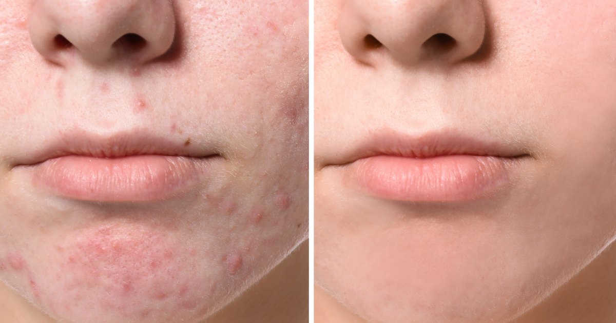 La Roche-Posay Vitamin C Serum Could Assist Management Breakouts La Roche-Posay Vitamin C Serum Could Assist Management Breakouts