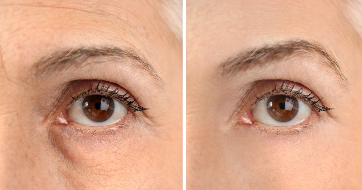 Wealthskin Eye Cream Might Get Rid of Puffiness in Simply 2 Minutes Wealthskin Eye Cream Might Get Rid of Puffiness in Simply 2 Minutes