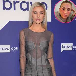 'Vanderpump Rules' Star Lala Kent Shares Photo of Her Bruised Face After Microneedling Procedure - 196