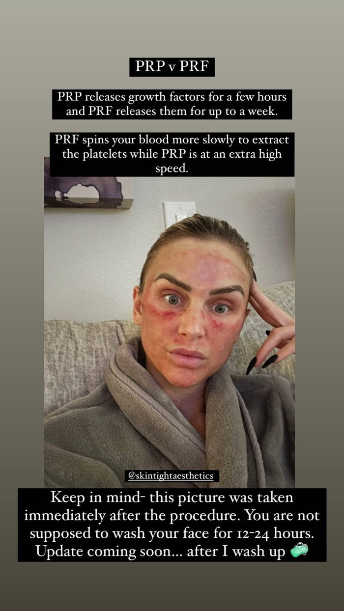 'Vanderpump Rules' Star Lala Kent Shares Photo of Her Bruised Face After Microneedling Procedure - 198