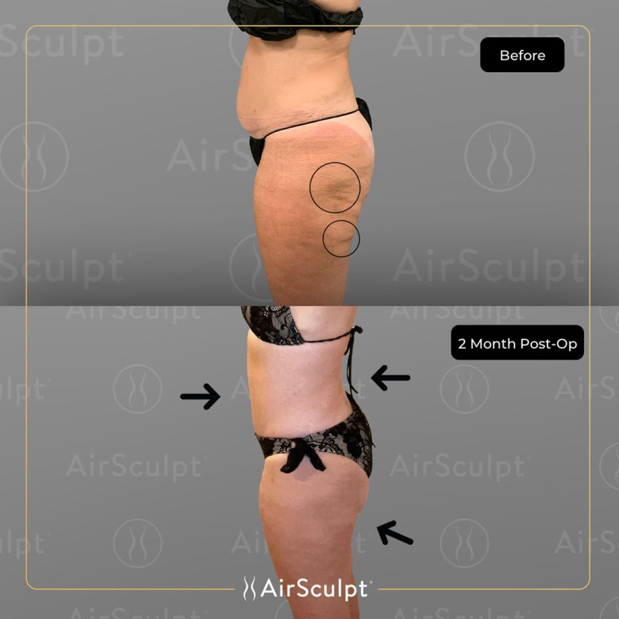 How is AirSculpt's Thigh Gap Surgery Different Than A Lift?