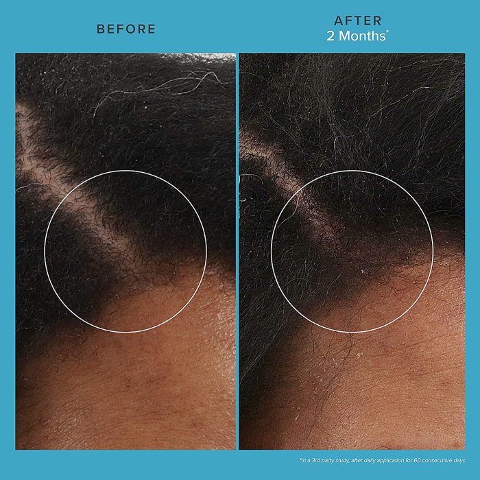 living-proof-revitalizing-scalp-treatment-before-after-2-months
