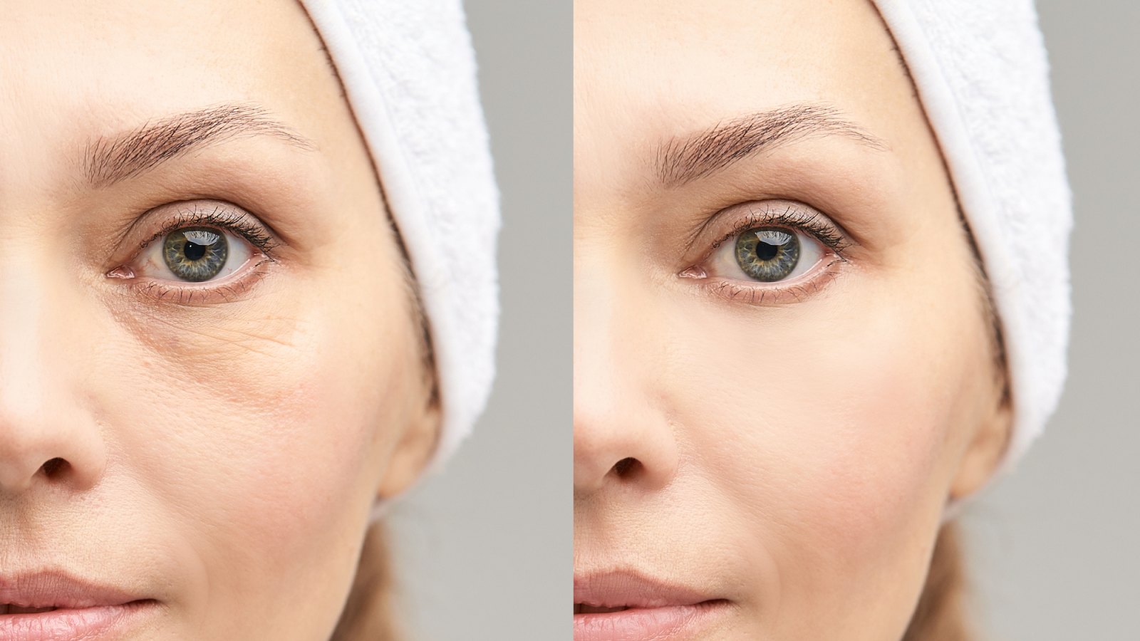 Before-After-Eye-Lift-Treatment-Stock-Photo