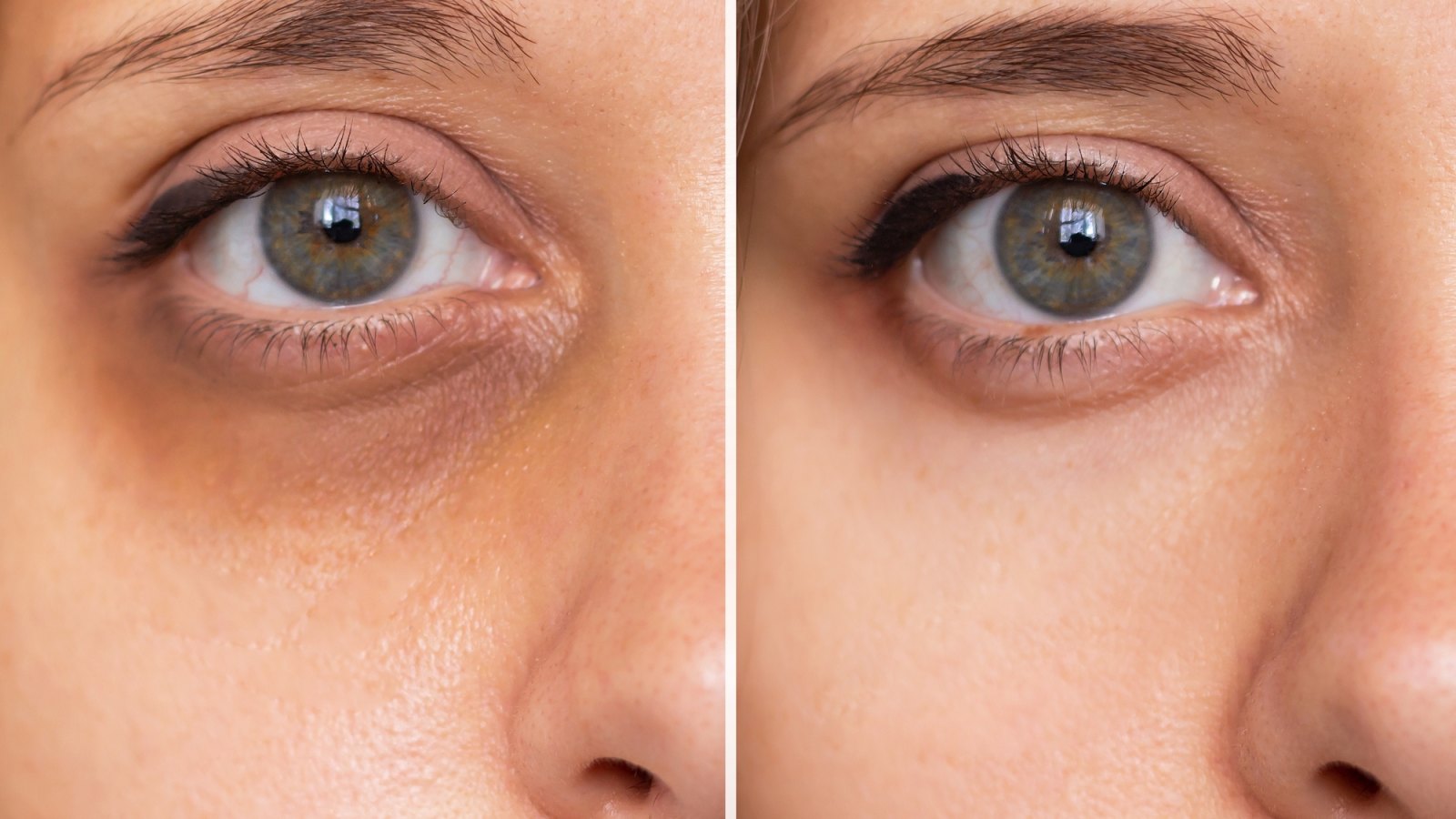 Dark-Circle-Before-After-Treatment-Stock-Photo