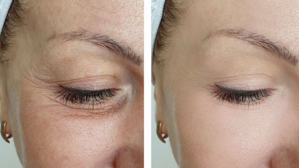 Upper-Eye-Lift-Treatment-Stock-Photo