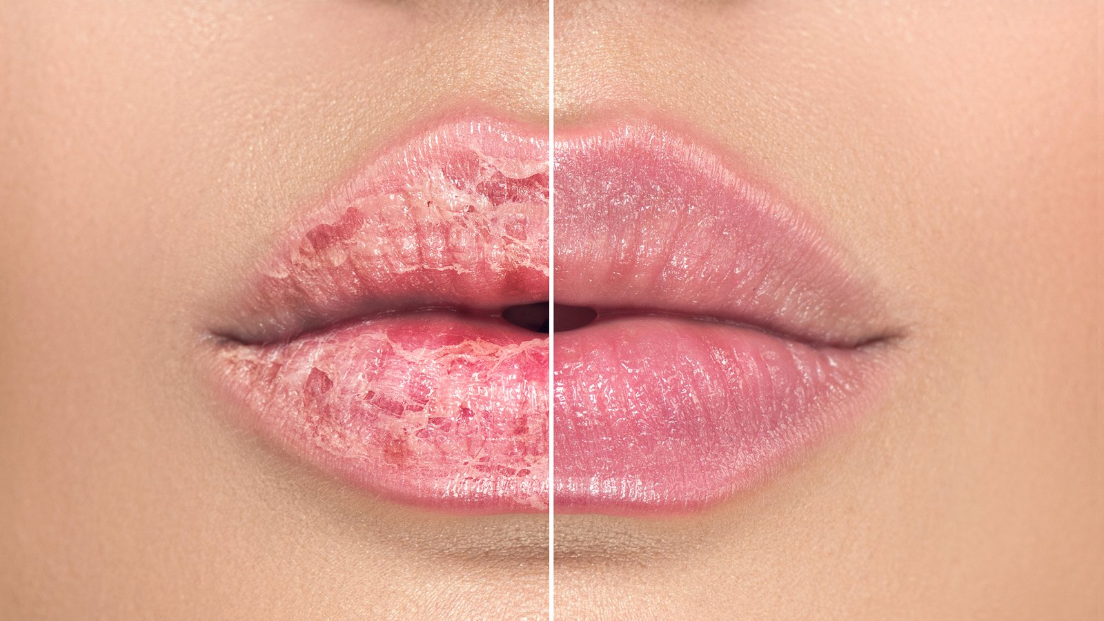 chapped-lips-before-after