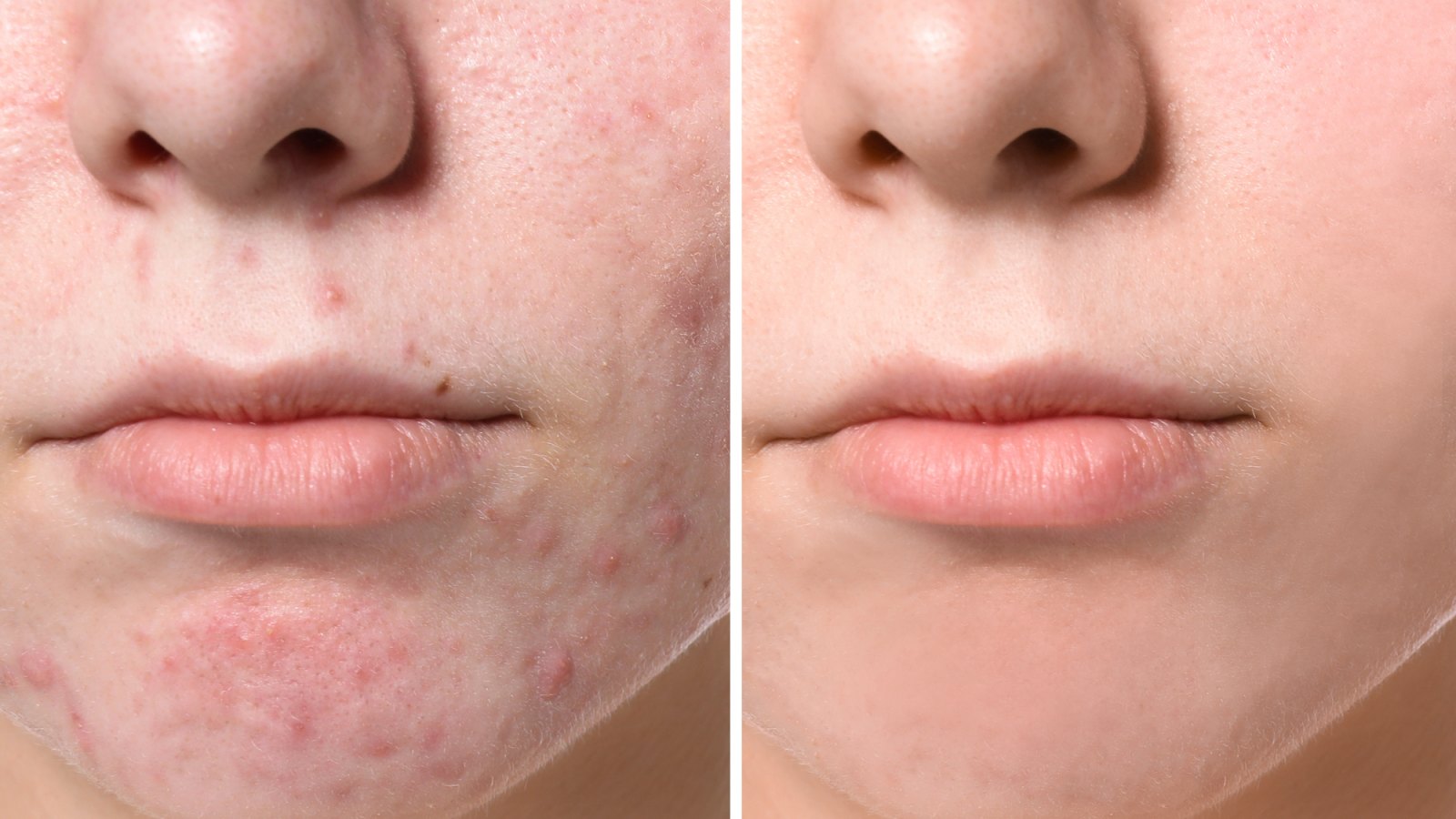 Before-After-Acne-Serum-Stock-Photo