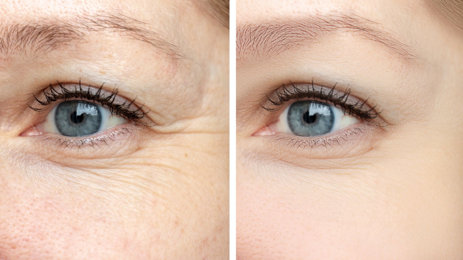Eye-Wrinkles-Before-After-Stock-Photo