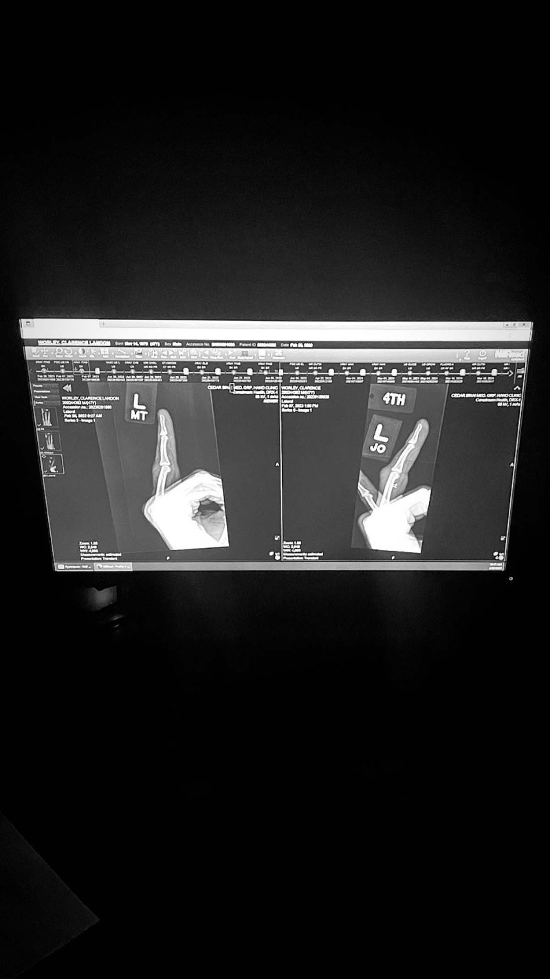 Travis Barker broken finger