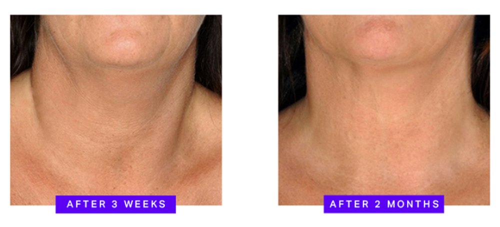 amazon-blumbody-neck-smoothing-pads-results