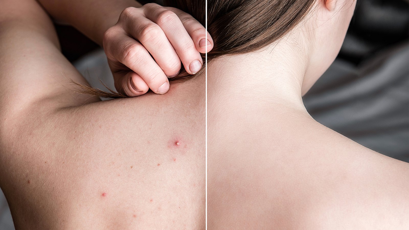 body-acne-before-after