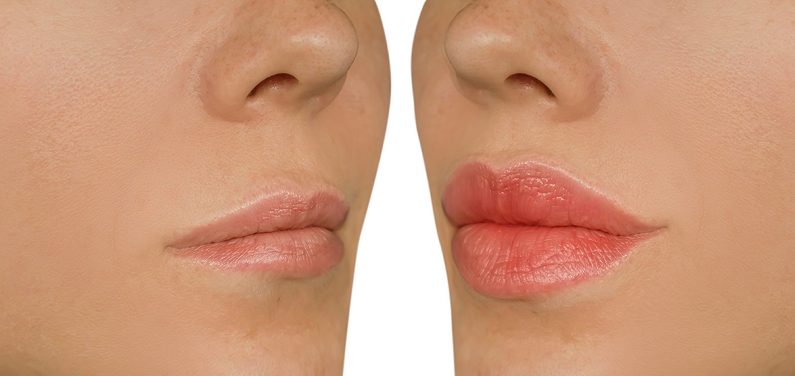 plump-lips-before-after