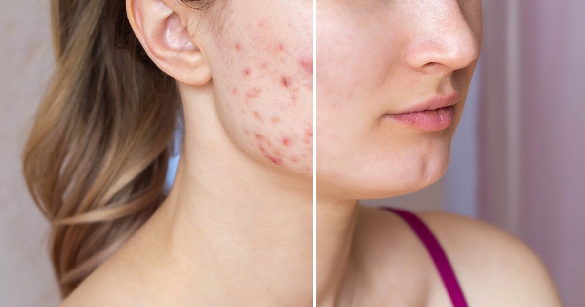 Acne Before After Stock Photo