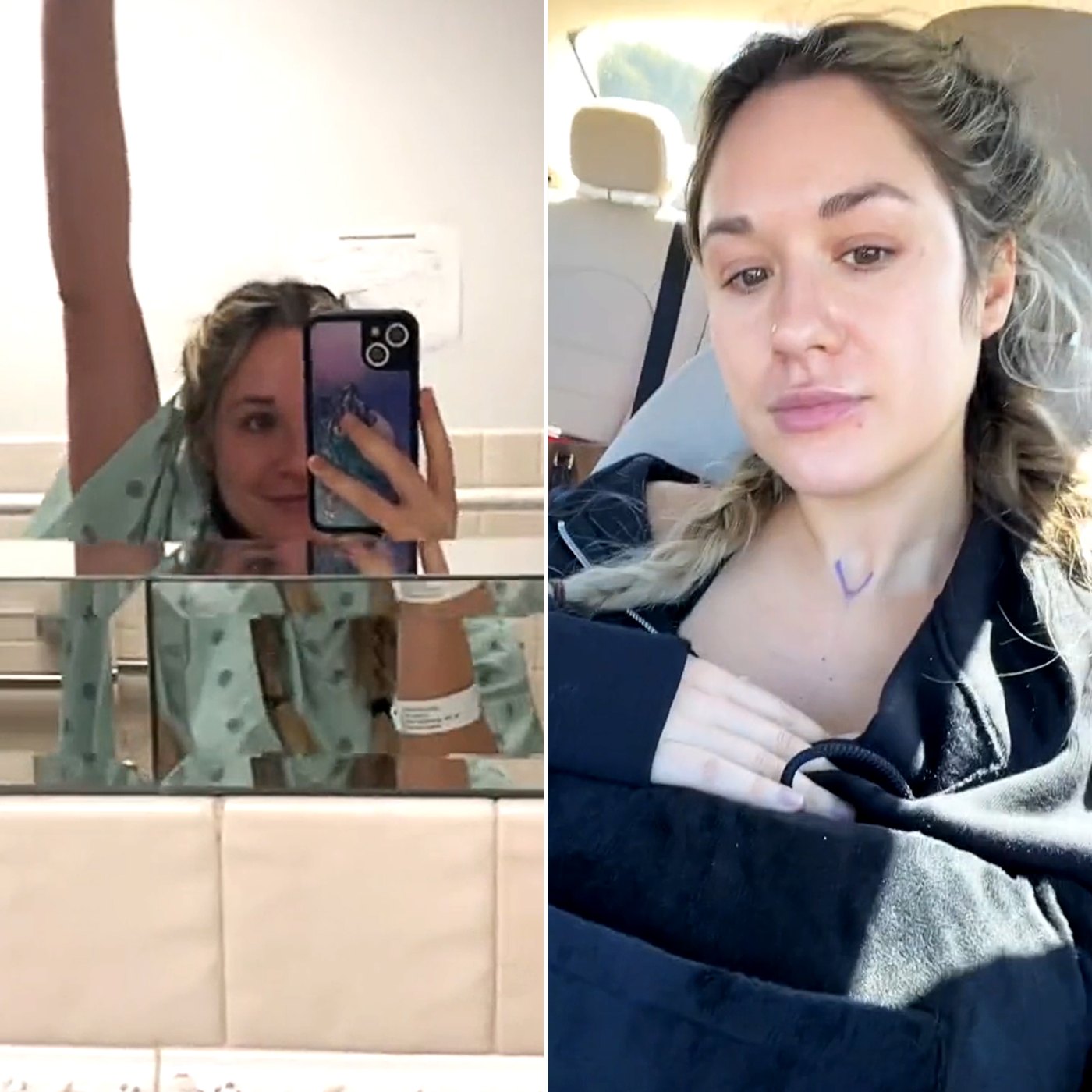 Rachel Raccia Rachel Recchia Is ‘Doing Well’ After Breast Reduction Surgery - Us