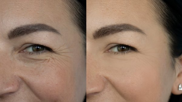 Before-After-Wrinkle-Closeup-Shot-Stock-Photo