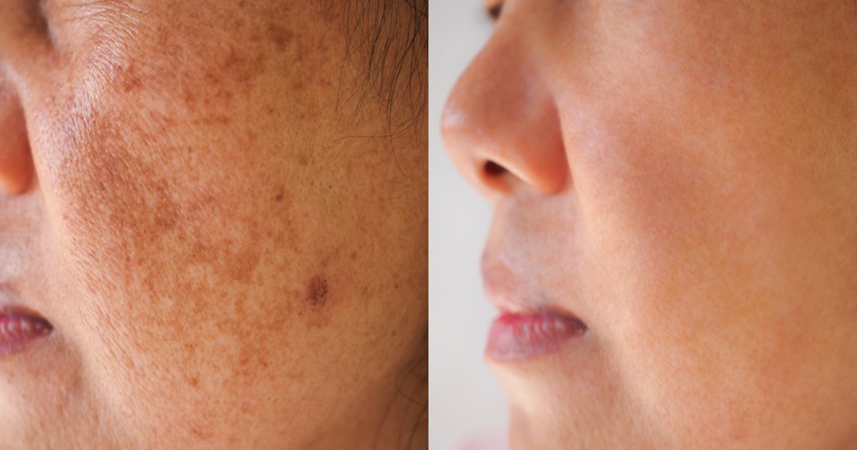 Dark Spot Before After Stock Photo 2