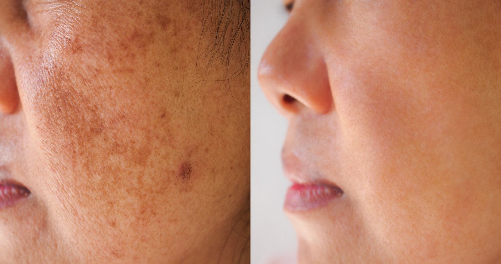 Dark-Spot-Before-After-Stock-Photo