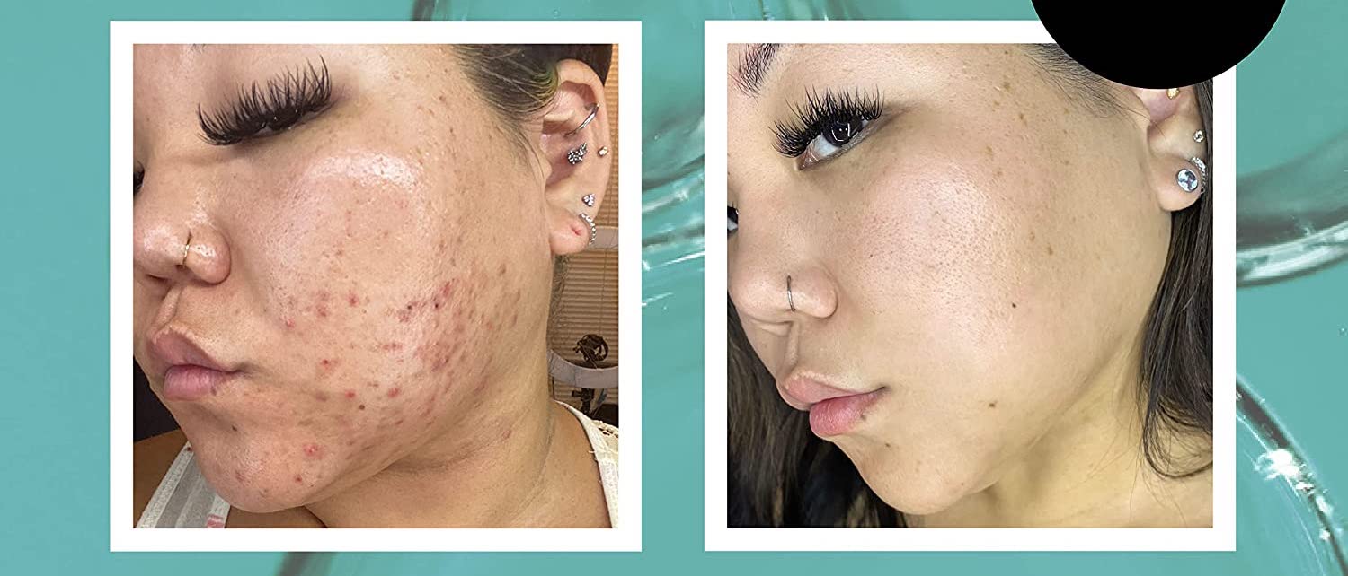 This $17 Serum Is Making Cystic Acne a Thing of the Past for Shoppers