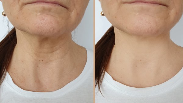 Neck-Wrinkles-Before-After-Stock-Photo