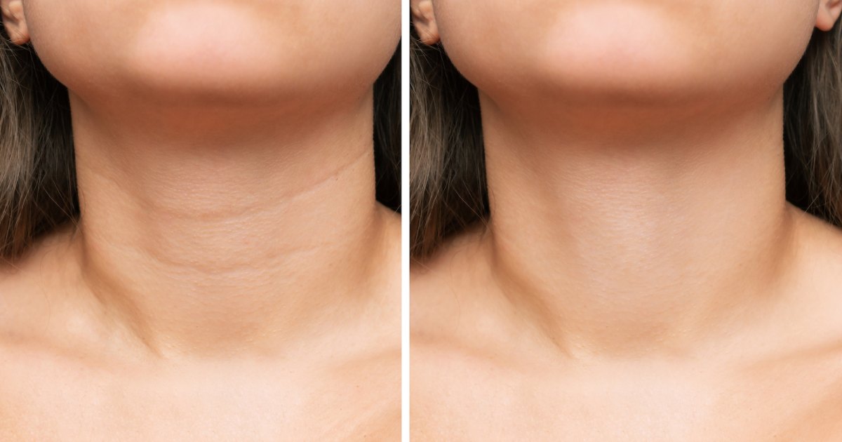 RoC Neck Cream May Improve Wrinkles in As Little as 4 Weeks