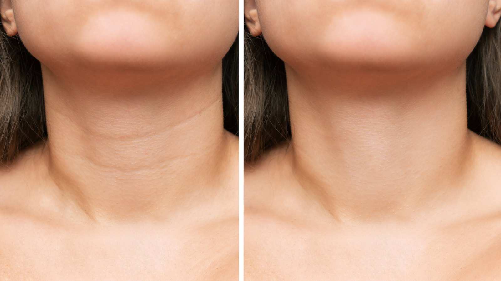 Neck-Wrinkles-Before-After-Stock-Photo