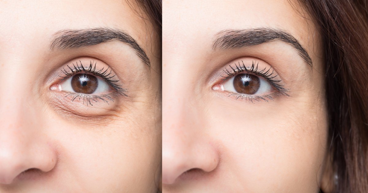 Puffy Eye Before After Stock Photo