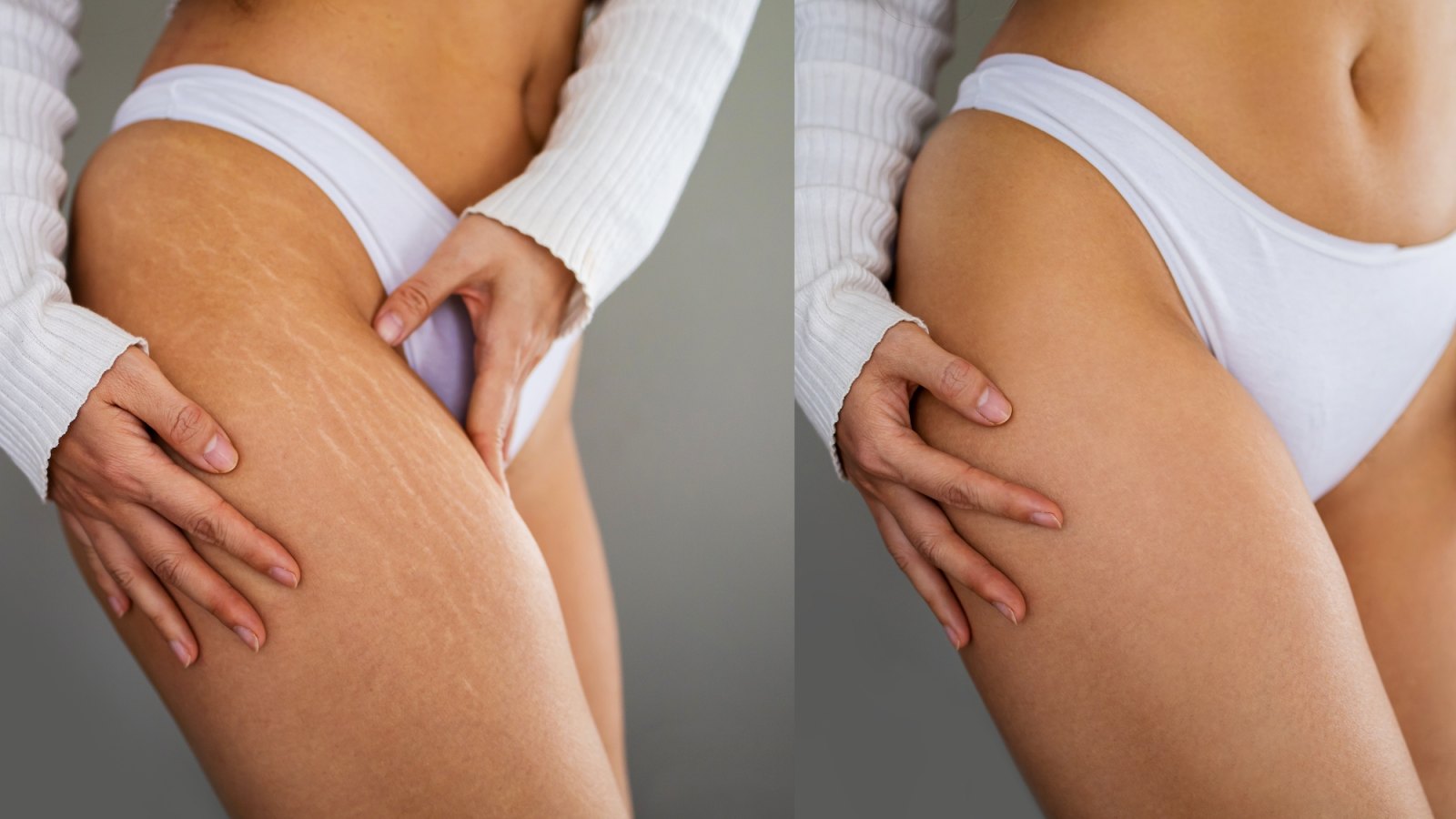 Stretch-Marks-Before-After-Stock-Photo