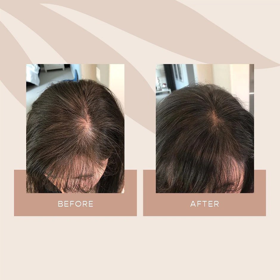 Hair Loss Treatment Products, Best Hair Fall Products Online – Amor beautee