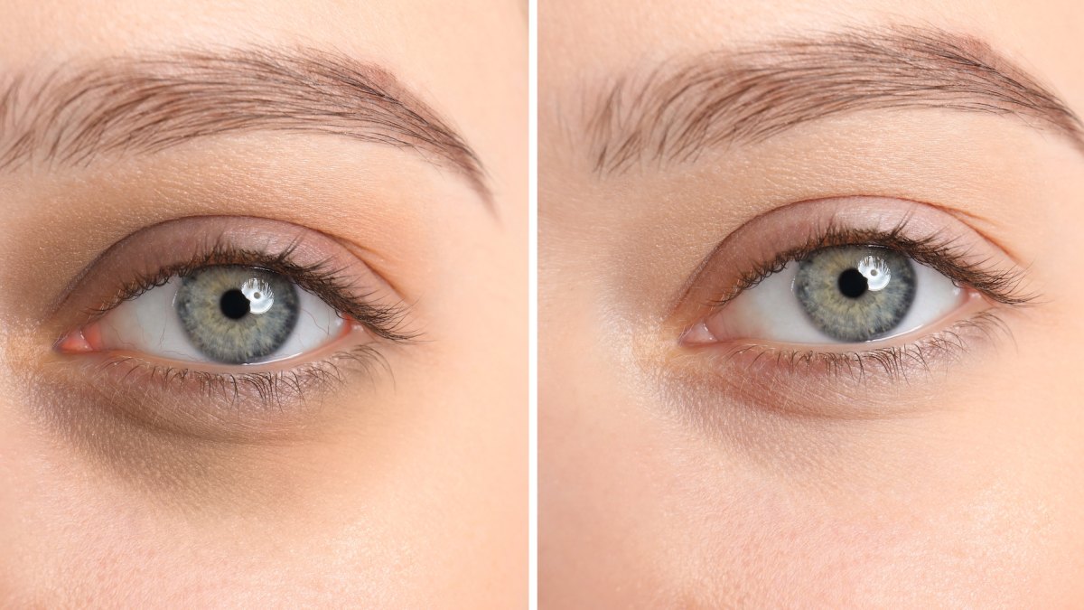 Before-After-Dark-Circle-Stock-Photo