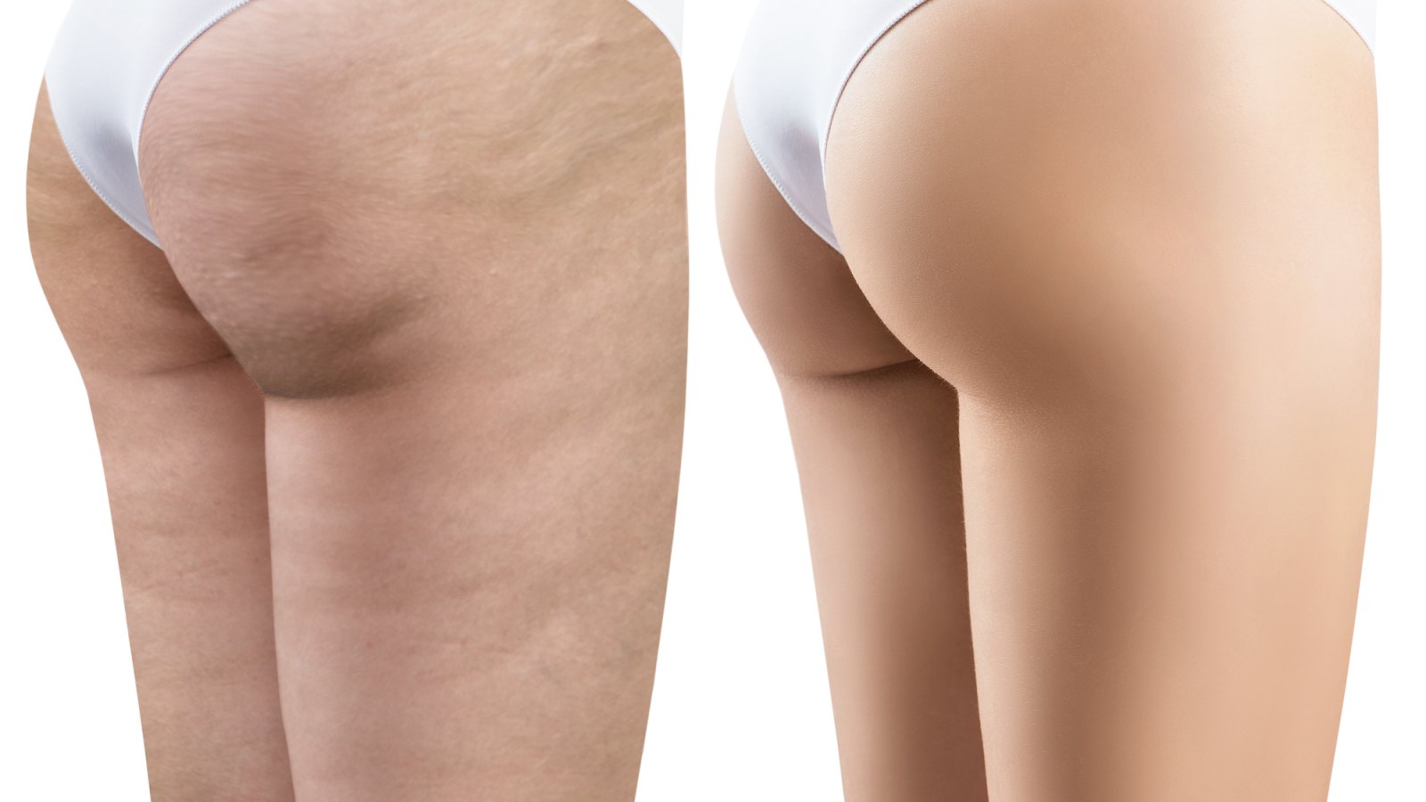Cellulite-Before-and-After-Stock-Photo