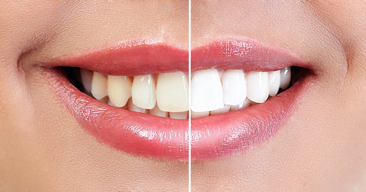 White Teeth Before After Stock Photo