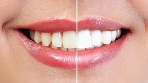 White-Teeth-Before-After-Stock-Photo