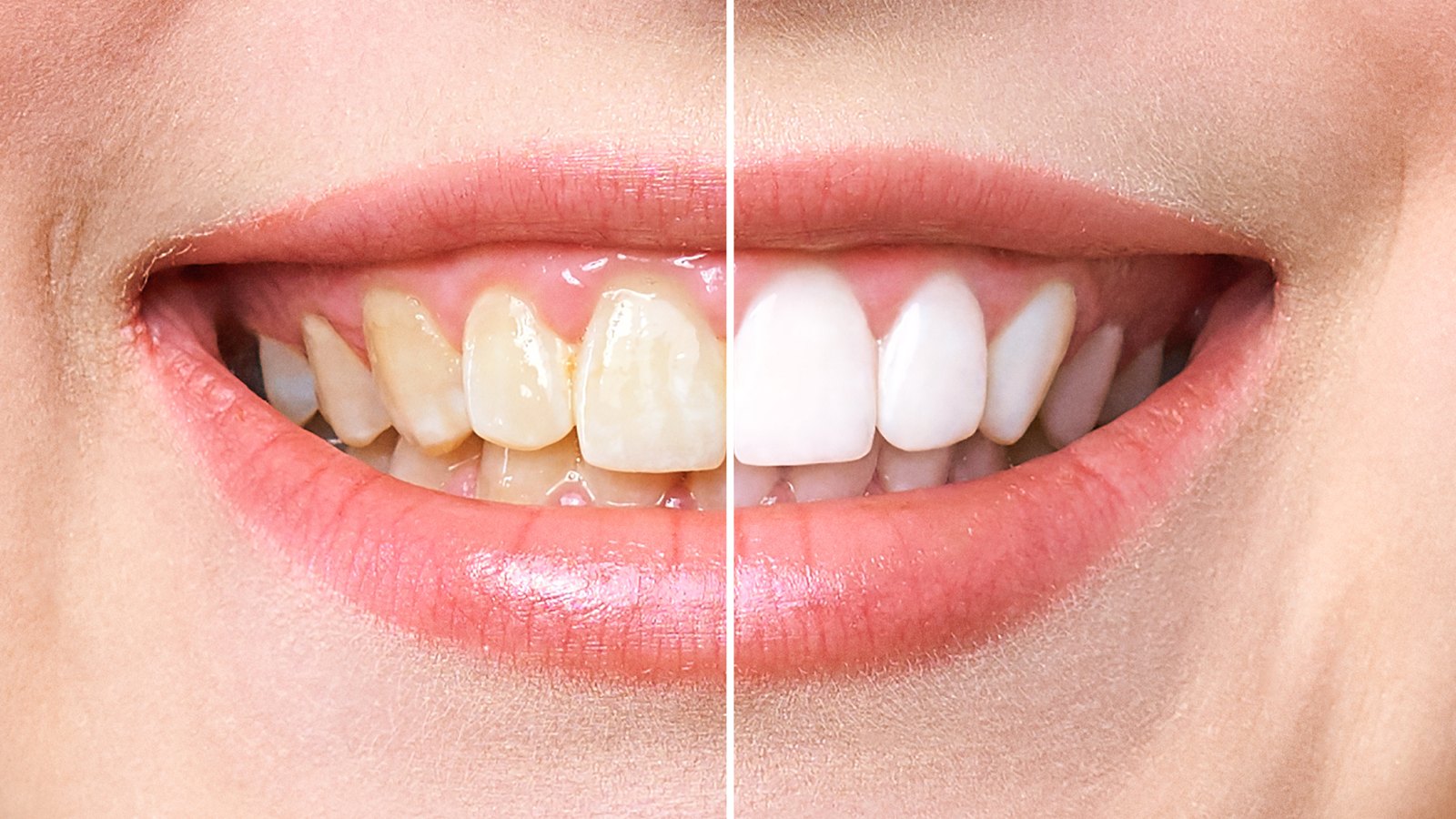 amazon-teeth-whitening-deals