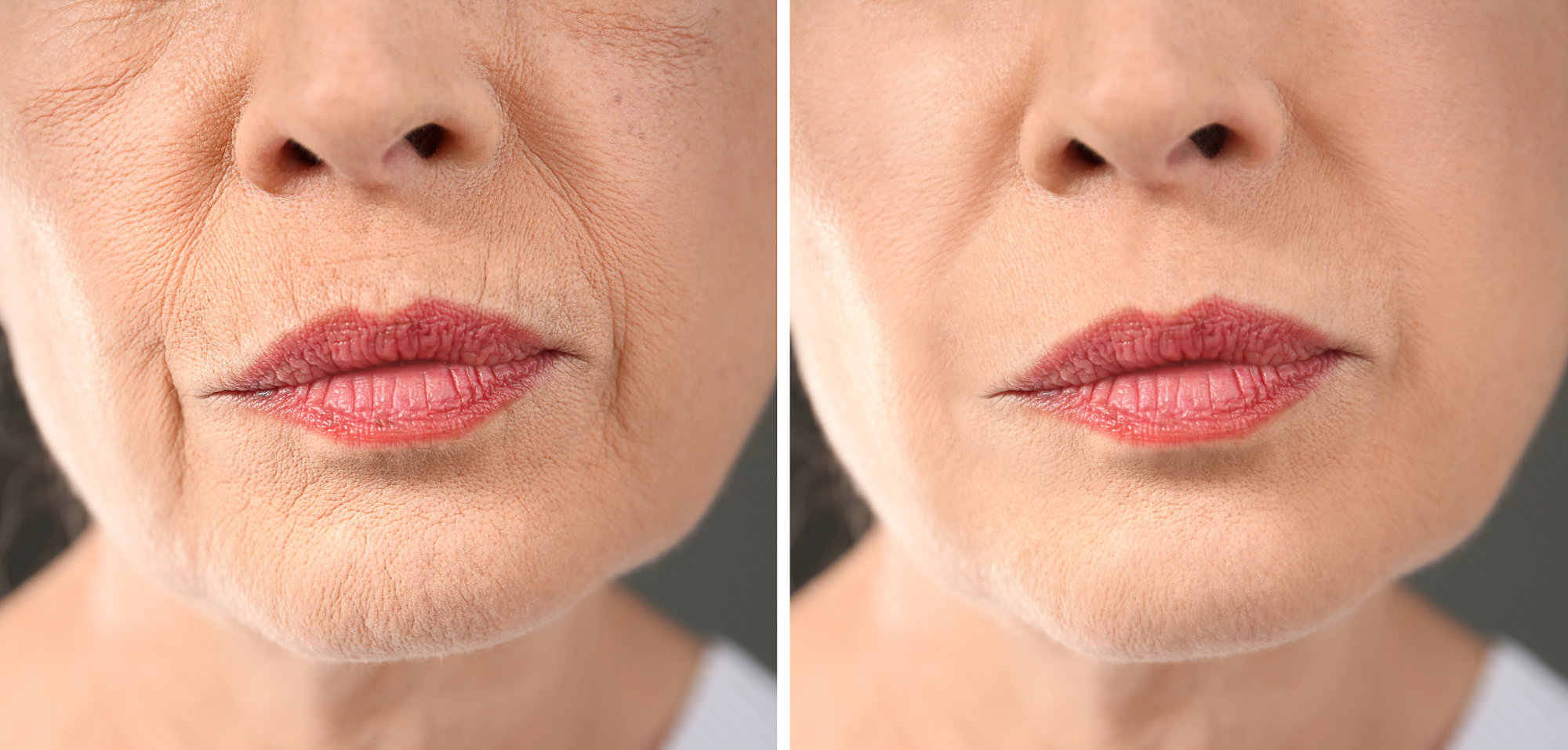 https://www.usmagazine.com/wp-content/uploads/2023/04/dermelect-smooth-upper-lip-professional-perioral-anti-aging-treatment.jpg?quality=86&strip=all