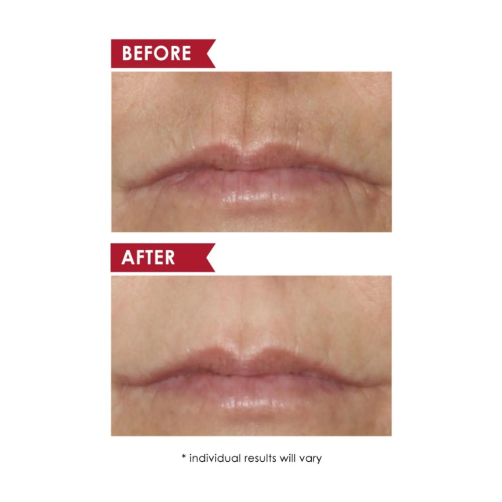 dermelect-upper-lip-treatment-before-after