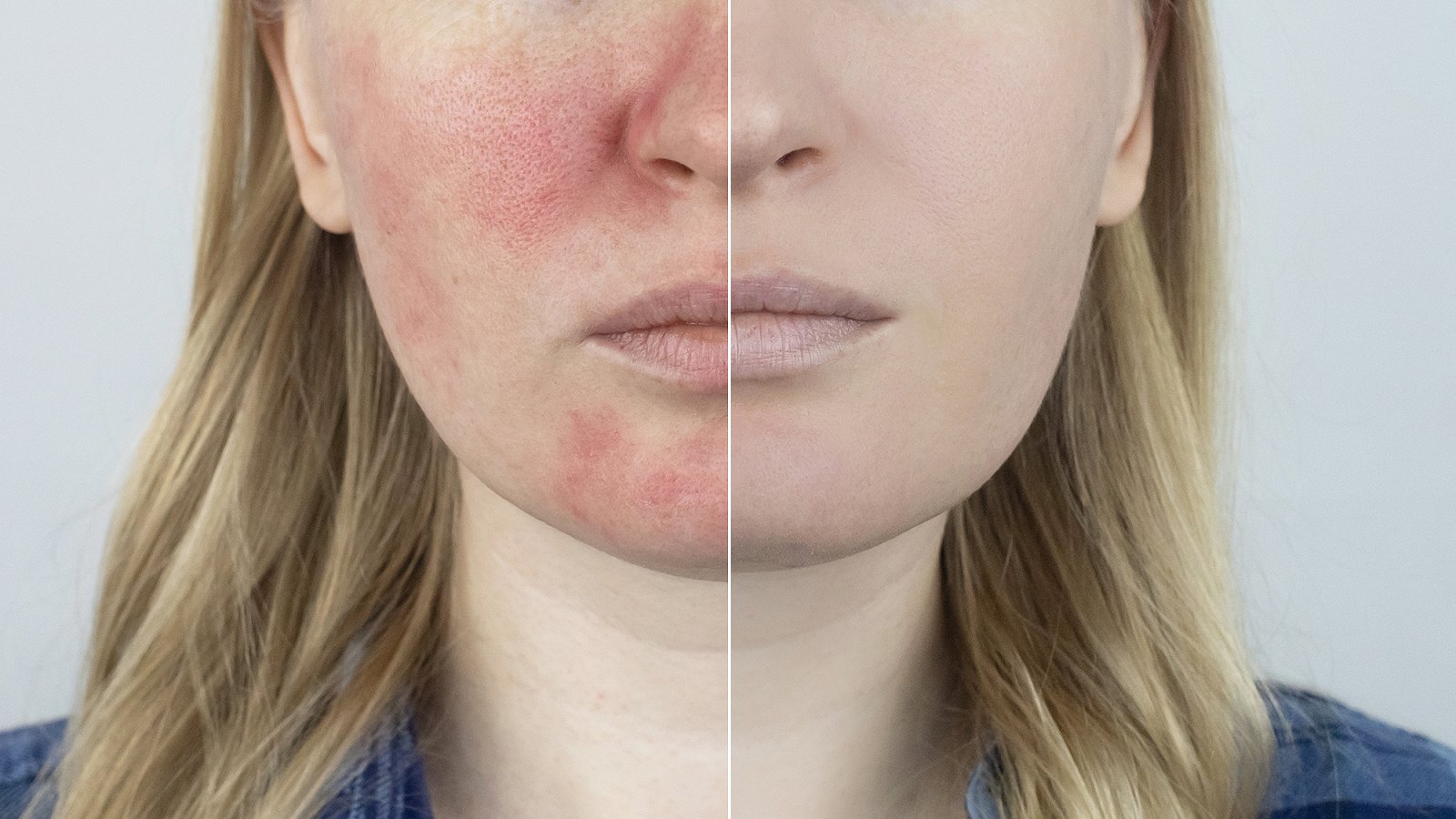 evian-facial-spray-red-irritatated-skin-before-after