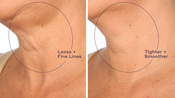 before-and-after-neck cream