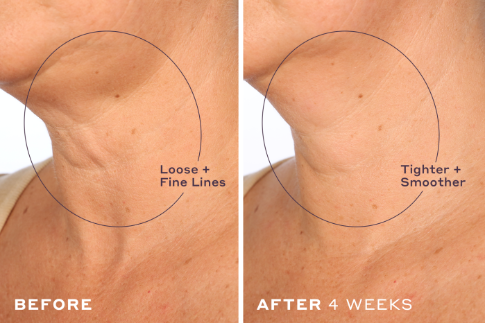 before-and-after-neck cream