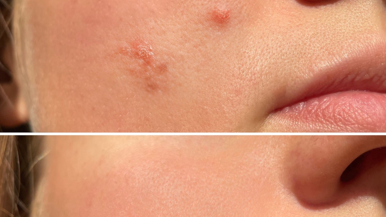 Acne-Treatment-Before-After-Stock-Photo