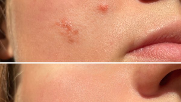 Acne-Treatment-Before-After-Stock-Photo