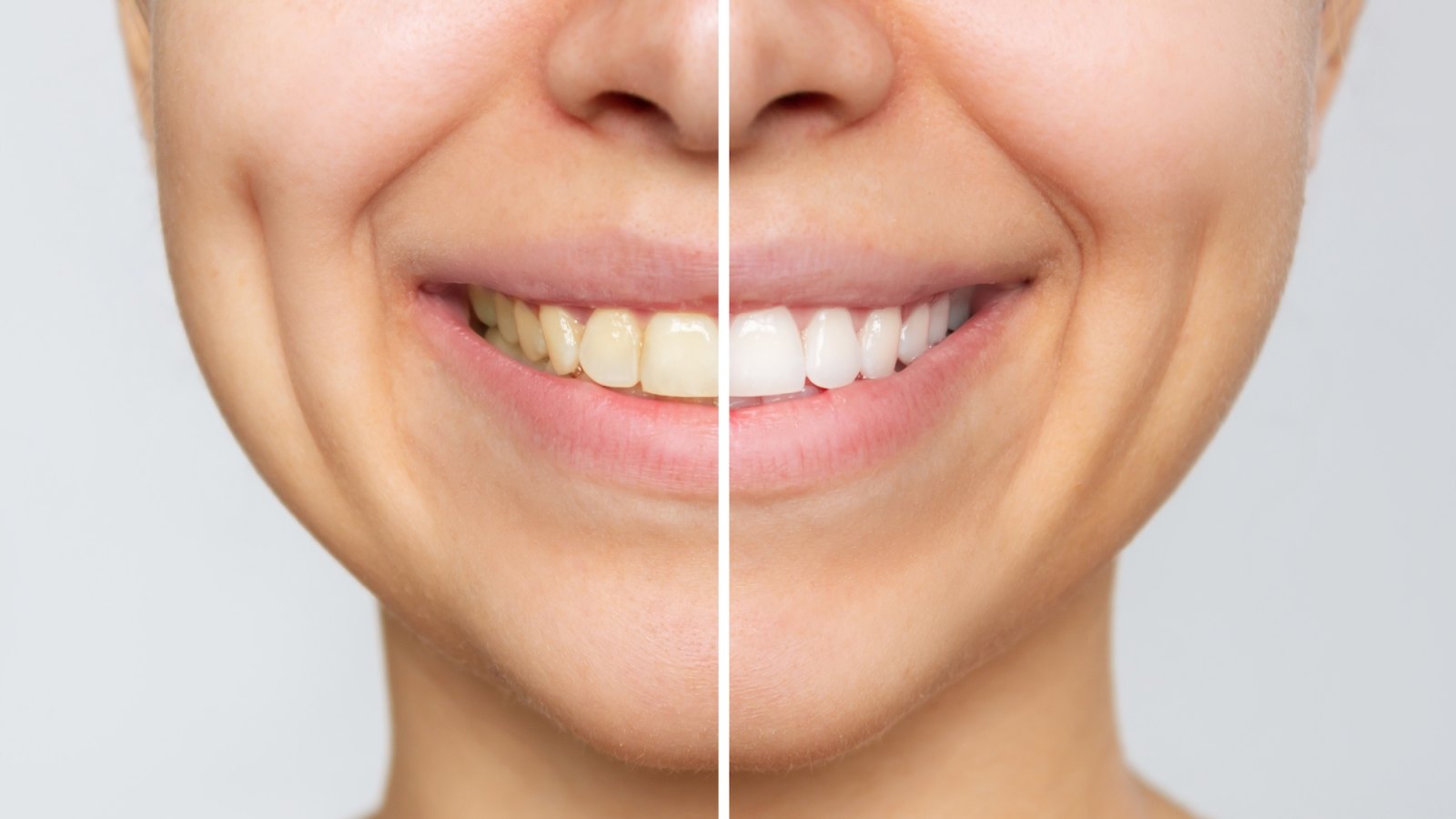 Before-and-After-Teeth-Cleaning-Stock-Photo