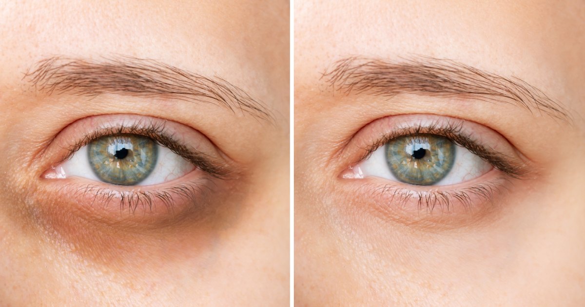 Farmacy Eye Cream Reduces the Size and Color of Dark Circles