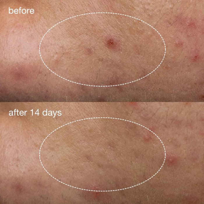 Deep Acne Invisible Liquid Patch