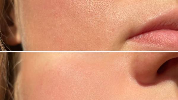 Skin-Pores-Bfore-After-Stock-Photo