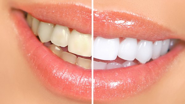 amazon-lumineaux-teeth-whitening-bright-pen