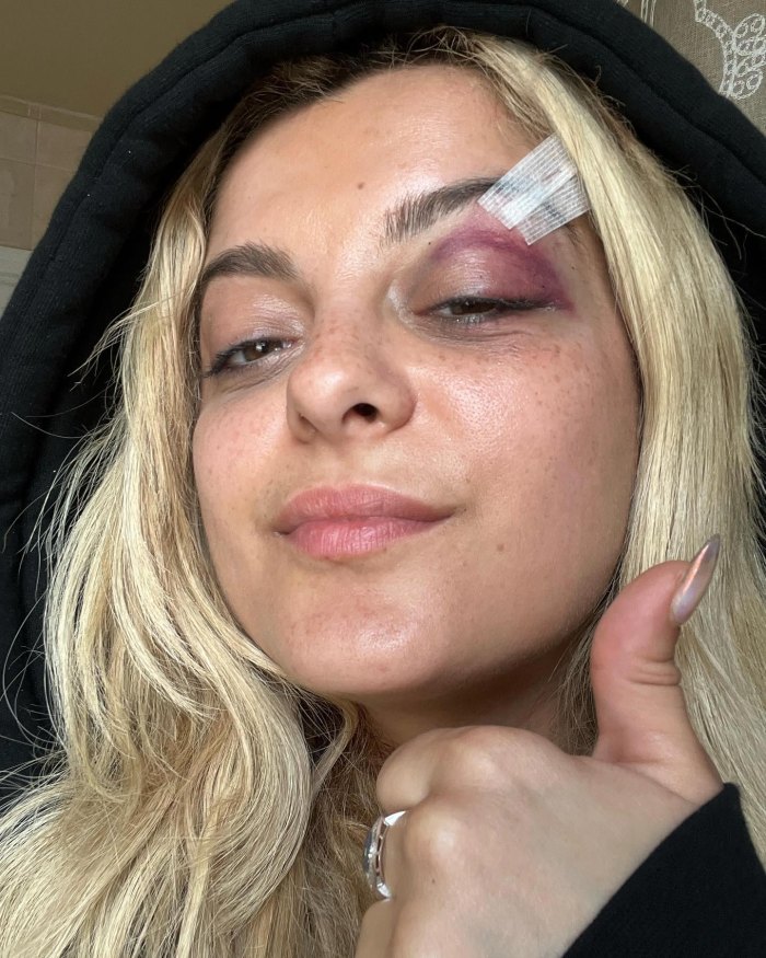 Bebe Rexha shares photos of Black Eye after fan throws phone in her face