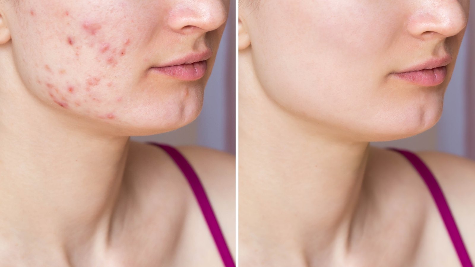 Best-Acne-Face-Washes-Stock-Photo