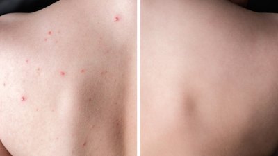 Body-Acne-Before-After-Stock-Photo